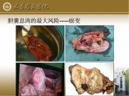 人体胆囊息肉图片 胆囊息肉最佳图片