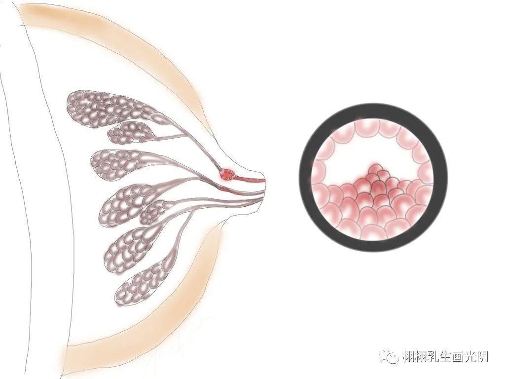 乳房结节 乳房结节3类需要注意什么